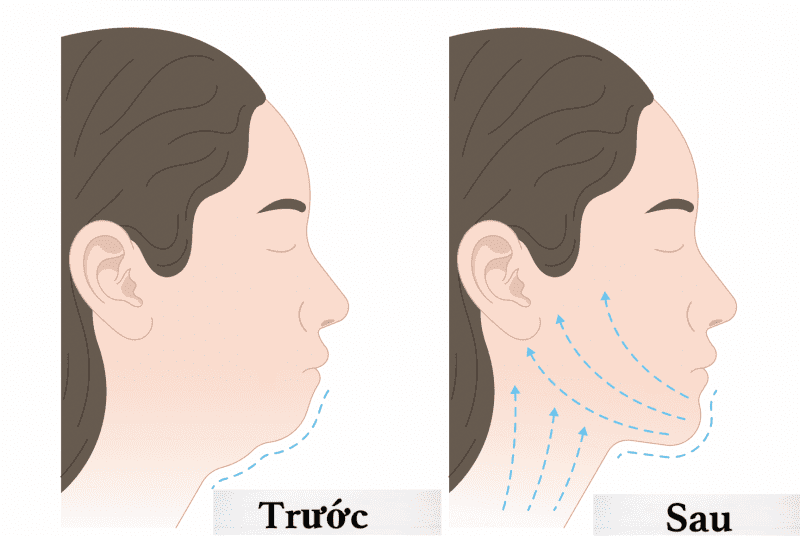 Độn cằm có đau không? Chi phí độn cằm hiện nay bao nhiêu?